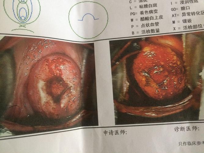 一年没怀孕以去医院看医生,医生检查是宫颈赘生物,还有宫颈管增生,有