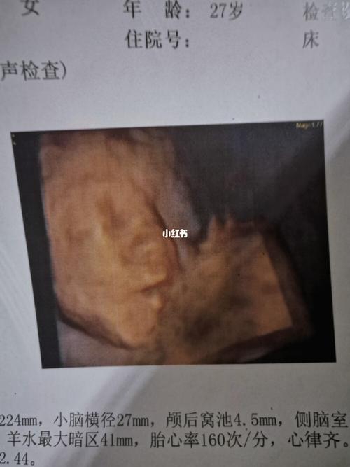 关于"四维彩超"_四维彩超_运动_月经_经期_四维彩超照
