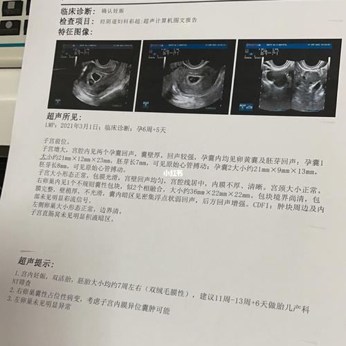 双胞胎_双胞胎_孕囊_母婴_孕产经验