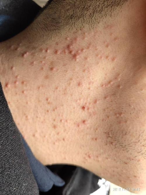 脖子上长了很多小痘痘,不太痒.这是什么原因?出现20天