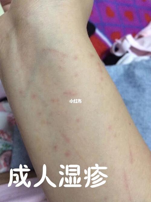 成人湿疹_湿疹_药膏_药店_止痒_成人湿疹_医疗健康