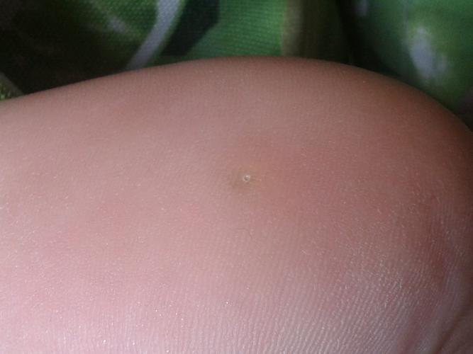 各位大哥,我这脚底长的这是什么?