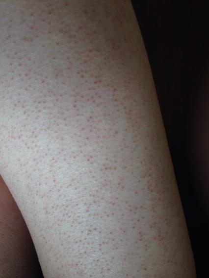 腿上和大胳膊上有鸡皮肤,感觉挺严重,夏天不含穿短裤,怎么办…怎么