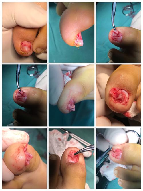 指甲长犄角是什么?原来是甲下骨疣