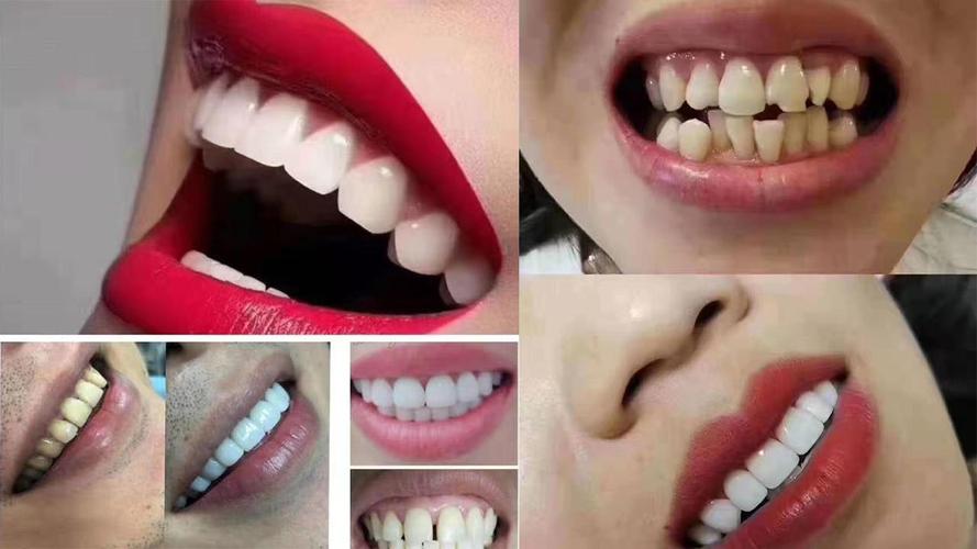 通过牙齿美白,可能很难起到很好的效果,因此可以采用烤瓷贴面,或者是