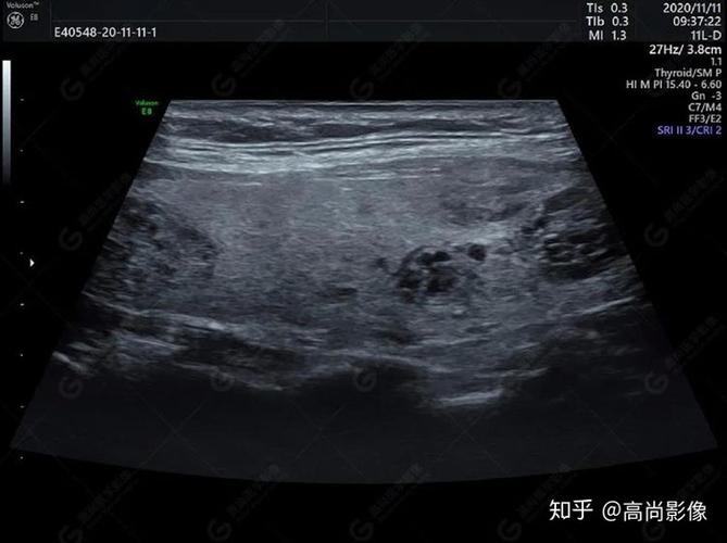 【高尚超声】浅表病例之结节性甲状腺肿