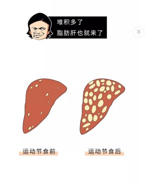 怎么样才能把脂肪肝给吃回去呢?做到这五点你就能成功!