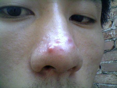 为什么鼻子上老长红痘痘两年了一直不怎么下?