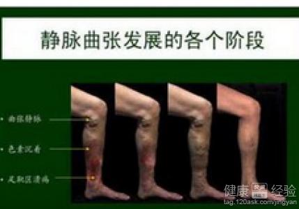 得了下肢静脉曲张怎样去预防