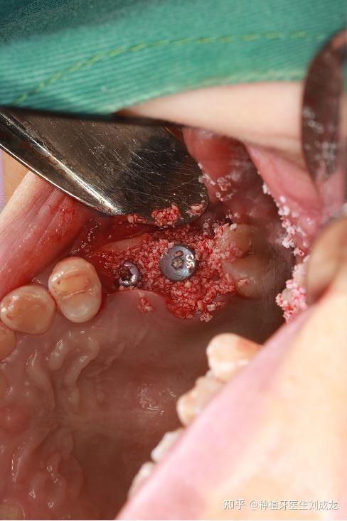 郑州种植牙|磨牙区多颗瑞士iti种植案例