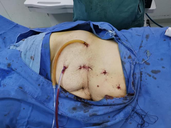 岳阳首例——一体位全腹腔镜输尿管癌根治术