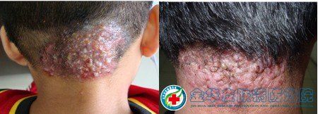 毛囊炎深入发展生成疖症状图—— 有类似症状 在线咨询专家