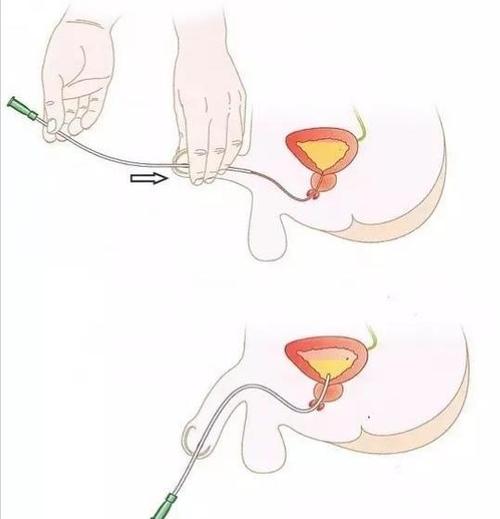 间歇性导尿患者的健康教育