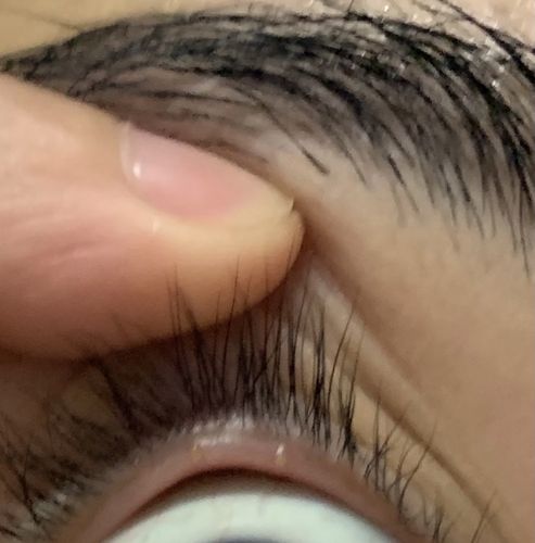 我眼睑里长了两个水泡有图慎入