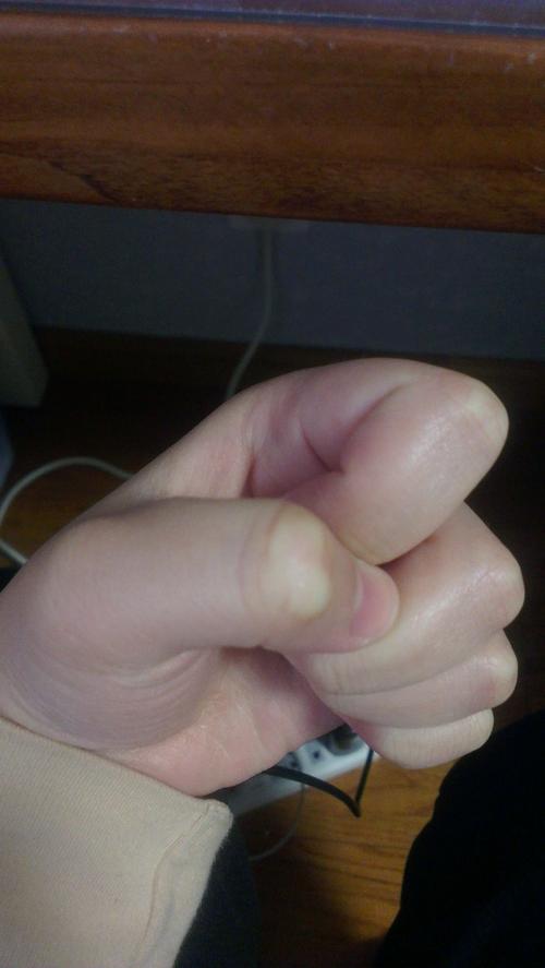 手指关节长硬了疙瘩,不痛也不痒