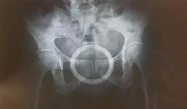 南岸区人民医院的盆腔x光射线检查结果