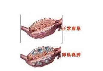 卵巢囊肿对身体的危害有哪些