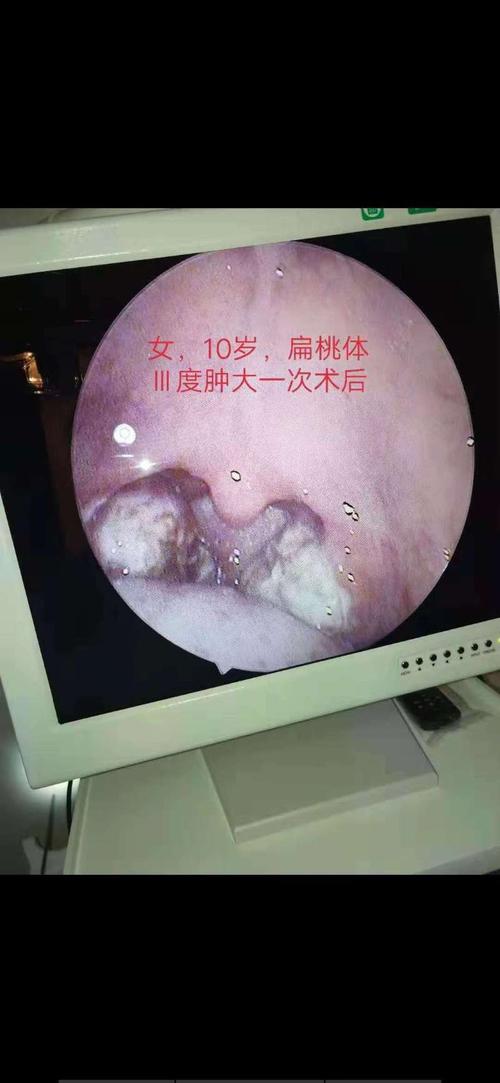 慢性扁桃体炎诊断及治疗指南