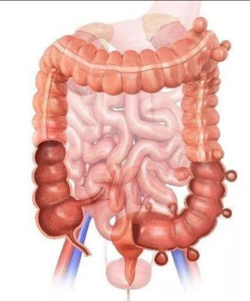 有种腹痛叫结肠憩室!