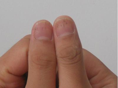 指甲上出现这的白点可以致命
