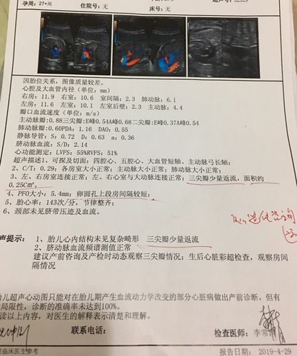 今天做了胎儿动态超声图,说是有三尖瓣少量反流,医生说没什么大问题