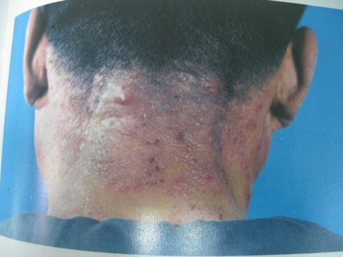 神经性皮炎(neurodermatitis)