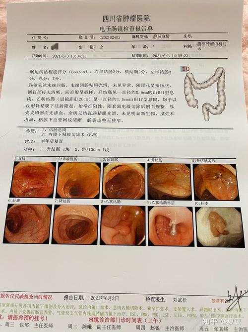 做肠镜是种怎样的体验
