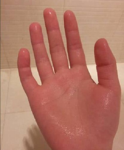 男生手心老是出汗是怎么回事?