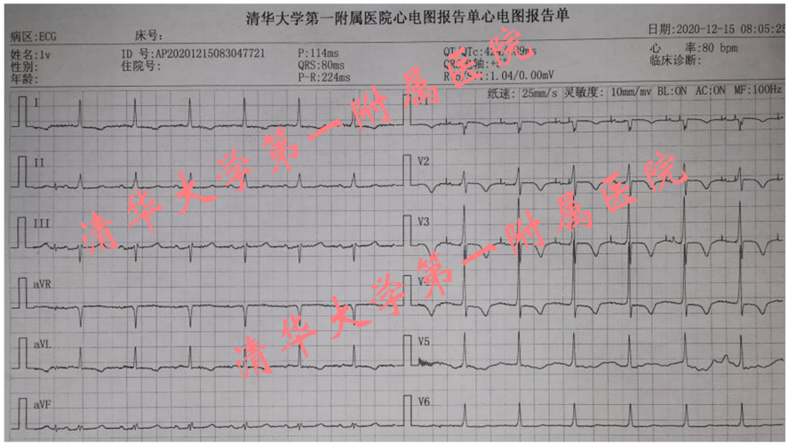 0t抗核磁长寿命起搏器 左束支区域起搏技术"——让心动过缓患者更长久