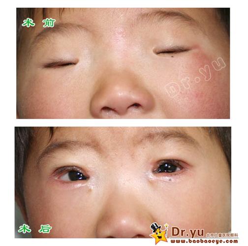 现代手术方法治疗儿童小眼球畸形(含小睑裂综合征)