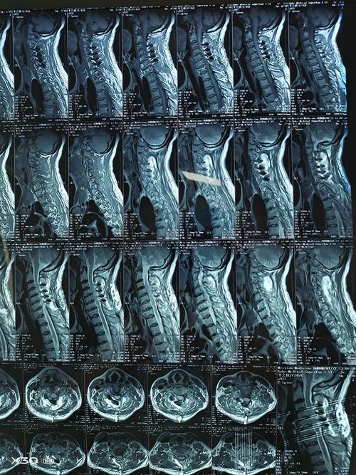 眉县中医院骨二科成功完成-颈后路单开门减压内固定术治疗颈椎管狭窄