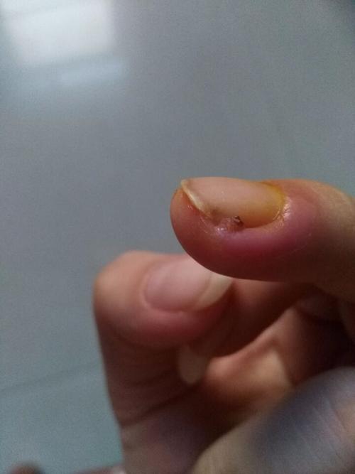 手指甲上一个倒刺被我拔掉以后,就发炎了,指甲缝里长出了一坨肉,一碰