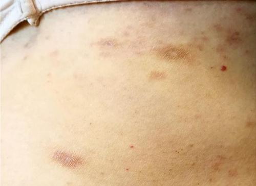 玫瑰糠疹会传染吗