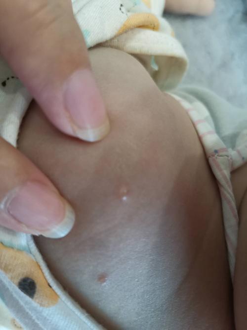 需要怎么治疗吗?能沾水吗?