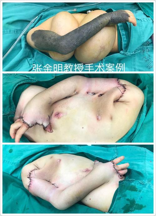 巨大黑痣巨痣扩张皮瓣完美修复
