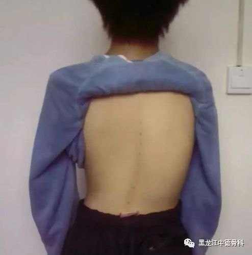 脊柱侧弯之后还能做运动吗?哪些运动不能做?