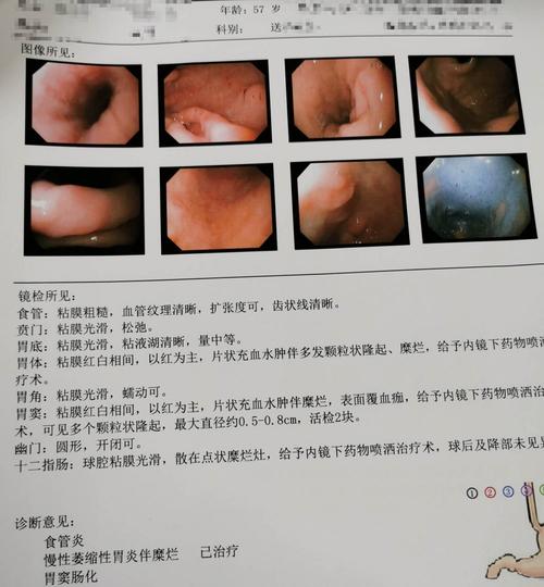 案例两年没复查慢性胃炎变肠化