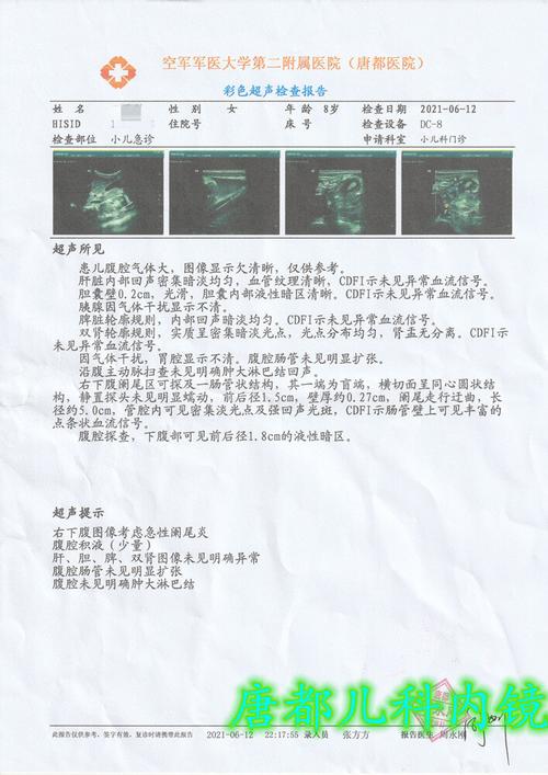儿童急性化脓性阑尾炎内镜治疗病例-20210613