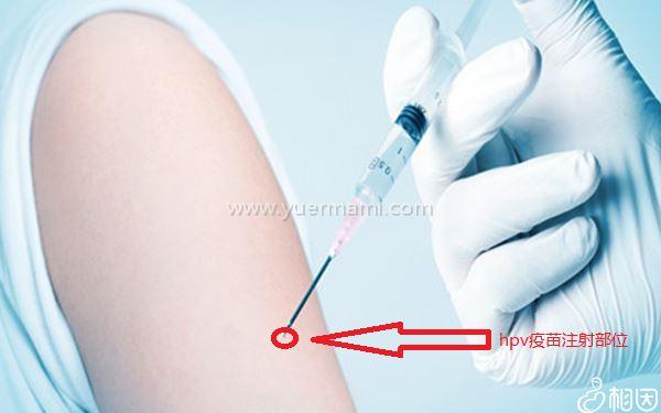 hpv宫颈癌疫苗注射部位图文解读