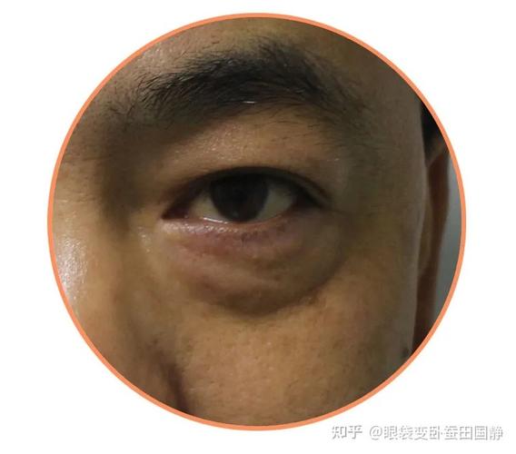 眼轮匝肌肥厚型眼袋