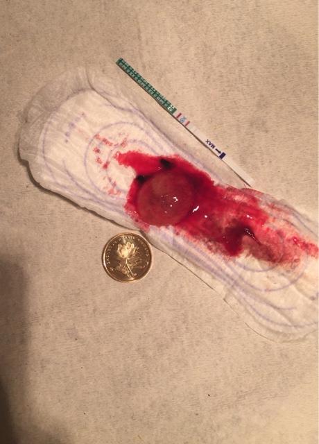 今天69天 感谢小猴子 2个月孕囊自然流产成功了 (有图