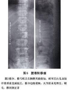 > 查看版本  图六有反应性的新骨形成常呈多发性穿凿样,虫蚀样骨破坏