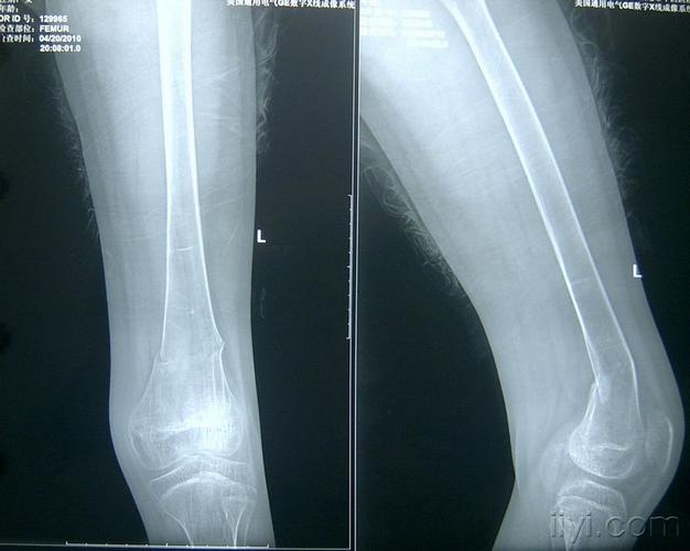 左股骨远端青枝骨折