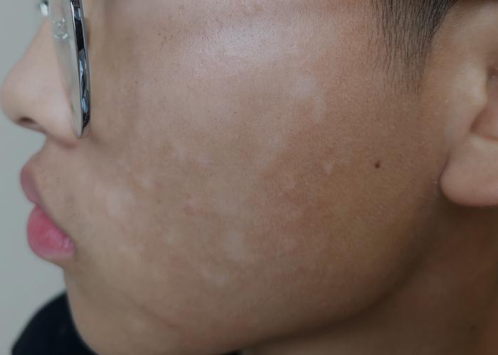 脸上的白斑是虫斑汗斑还是白癜风