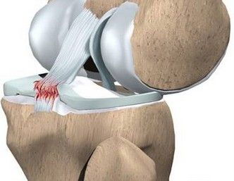 韧带断裂后,一般地膝关节内侧显著肿胀,局部发生剧痛,皮下淤血,青紫