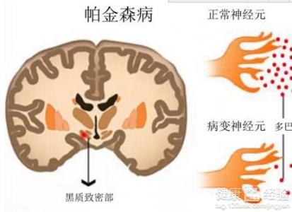 广州治疗帕金森哪里的医院好
