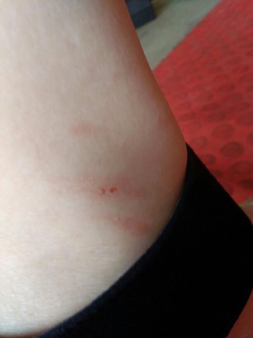 被邻居家的狗咬伤了,有点流血怎么办?