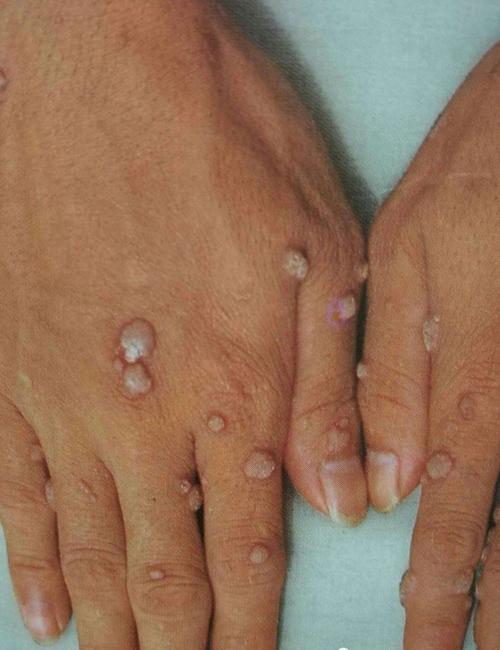 病毒性皮肤病—疣