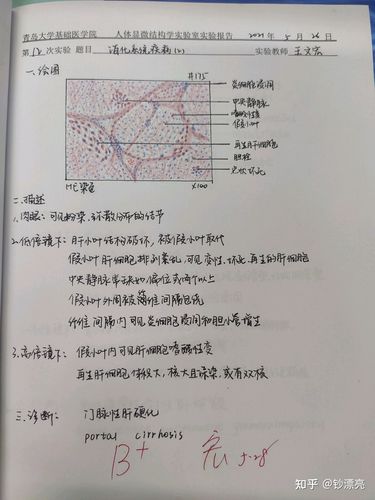 12.门脉性肝硬化