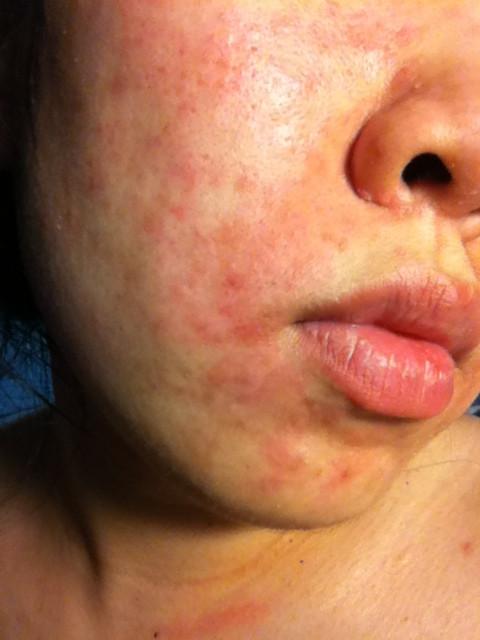 脸上起了一片红的怎么回事 健身